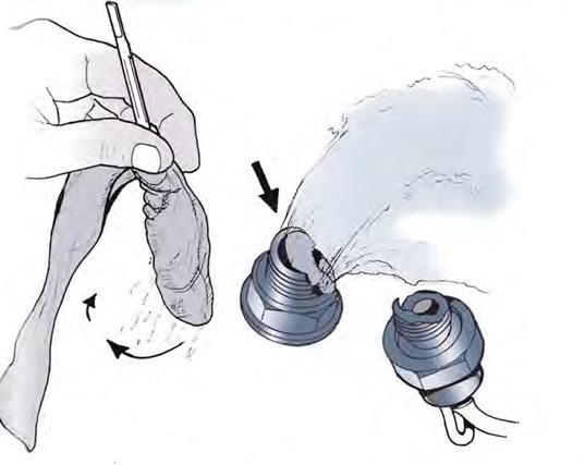 Provisorischer Stopfen
